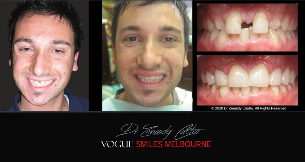 Close Gaps or Spacing Between Teeth Noble Park Dentist - Cosmetic Dental Clinic