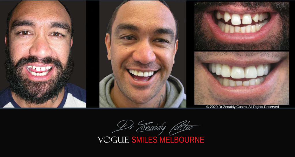 Close Gaps or Spacing Between Teeth Noble Park Dentist - Cosmetic Dental Clinic