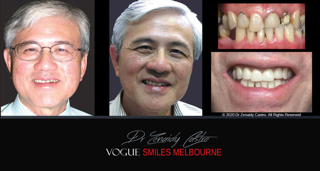 Porcelain Crown and Bridges by Gentle, family-friendly dental clinic in the Noble Park North - Affordable dental Crown Capping