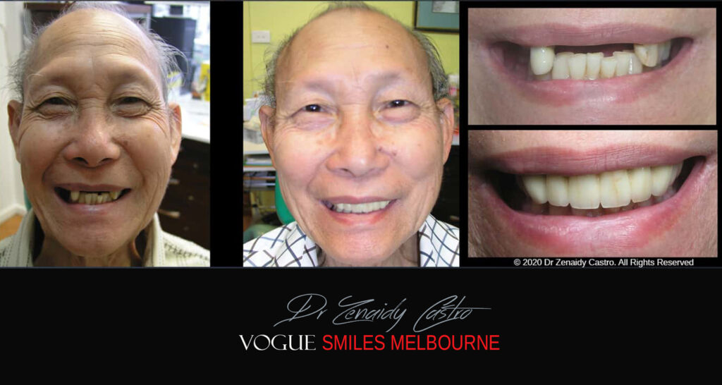 Porcelain Crown and Bridges by Gentle, family-friendly dental clinic in the Noble Park North - Affordable dental Crown Capping
