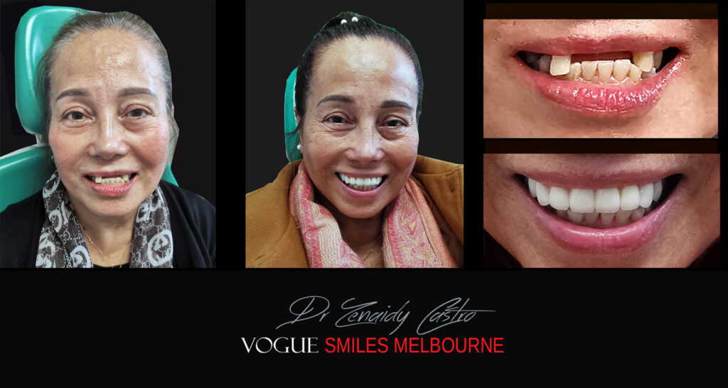 Porcelain Crown and Bridges by Gentle, family-friendly dental clinic in the Noble Park North - Affordable dental Crown Capping