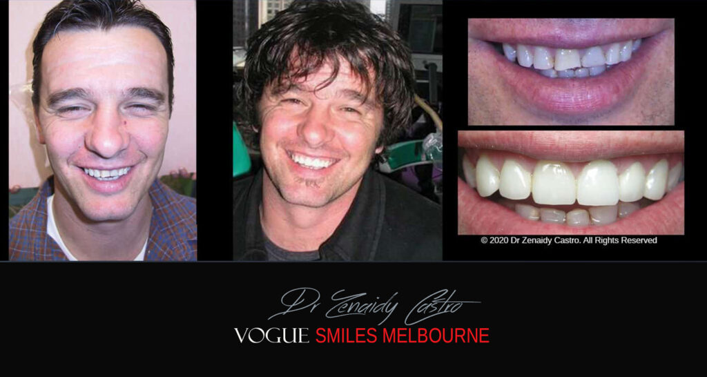 Porcelain Crown and Bridges by Gentle, family-friendly dental clinic in the Noble Park North - Affordable dental Crown Capping