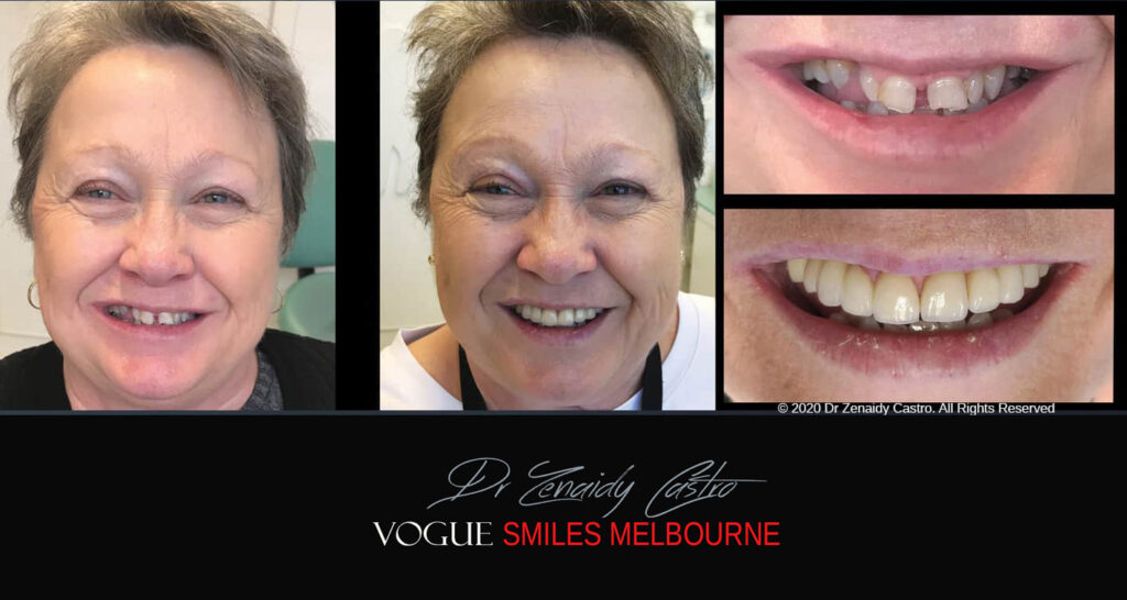Porcelain Crown and Bridges by Gentle, family-friendly dental clinic in the Noble Park North - Affordable dental Crown Capping
