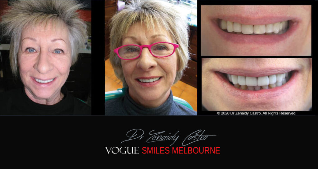 Porcelain Veneers near Wheelers Hill area - Before and After Pictures - Dental Veneers - Tooth Veneers - Top Cosmetic Dentist in Wheelers Hill