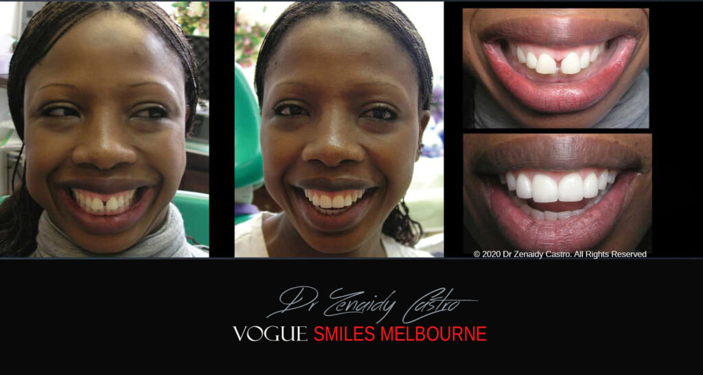 Porcelain Veneers near Wheelers Hill area - Before and After Pictures - Dental Veneers - Tooth Veneers - Top Cosmetic Dentist in Wheelers Hill