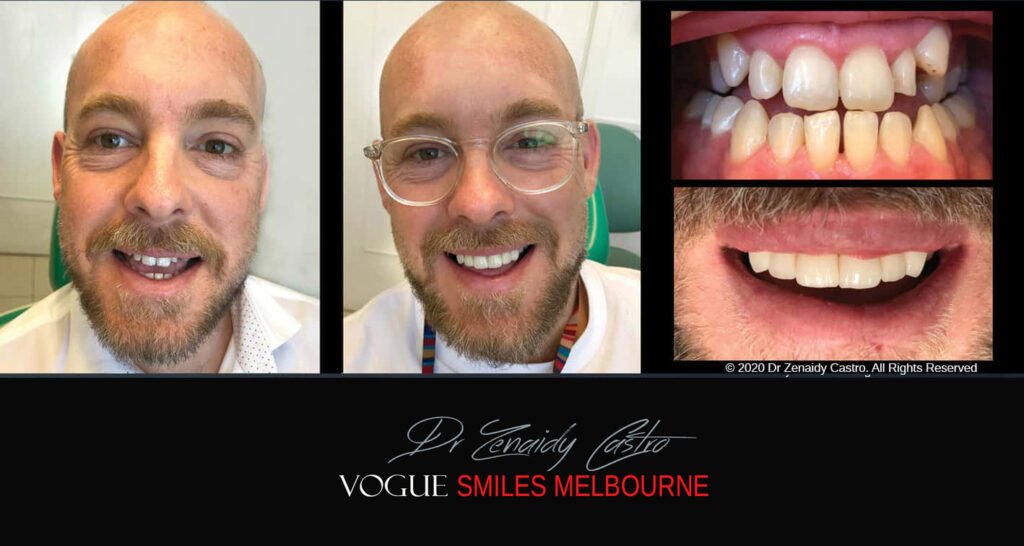 Porcelain Veneers near Wheelers Hill area - Before and After Pictures - Dental Veneers - Tooth Veneers - Top Cosmetic Dentist in Wheelers Hill