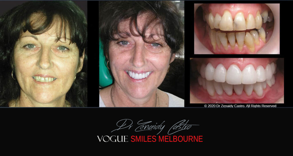 Porcelain Veneers near Wheelers Hill area - Before and After Pictures - Dental Veneers - Tooth Veneers - Top Cosmetic Dentist in Wheelers Hill