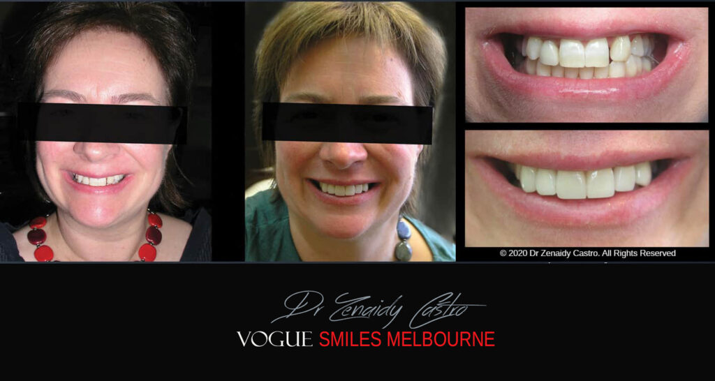 Porcelain Veneers near Wheelers Hill area - Before and After Pictures - Dental Veneers - Tooth Veneers - Top Cosmetic Dentist in Wheelers Hill