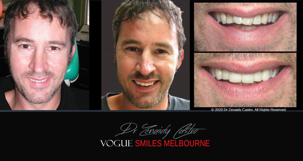 Porcelain Veneers near Wheelers Hill area - Before and After Pictures - Dental Veneers - Tooth Veneers - Top Cosmetic Dentist in Wheelers Hill