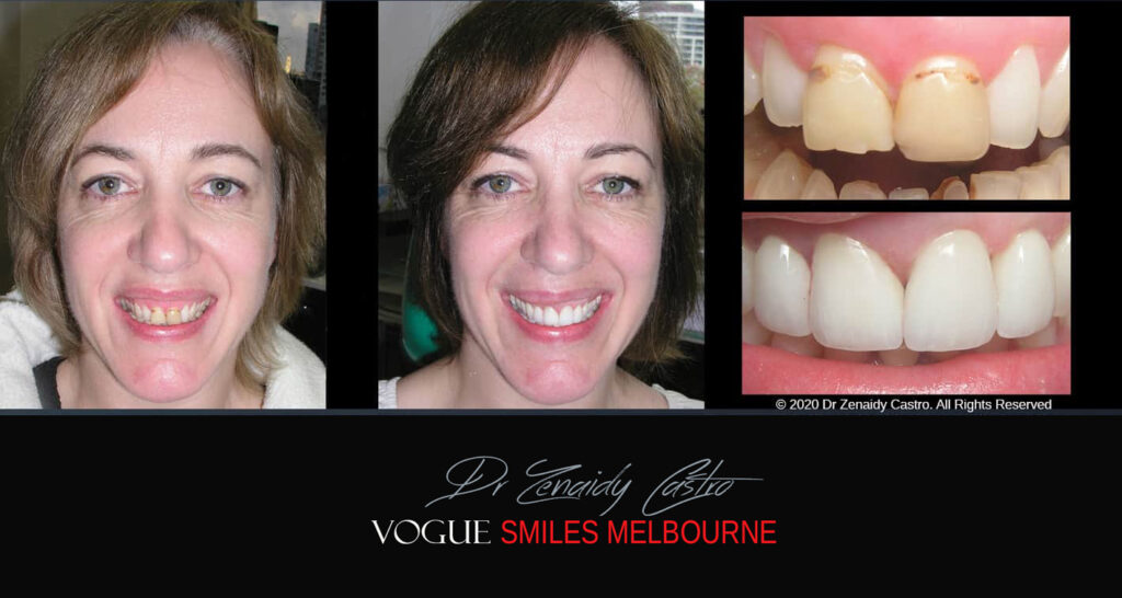Porcelain Veneers near Wheelers Hill area - Before and After Pictures - Dental Veneers - Tooth Veneers - Top Cosmetic Dentist in Wheelers Hill