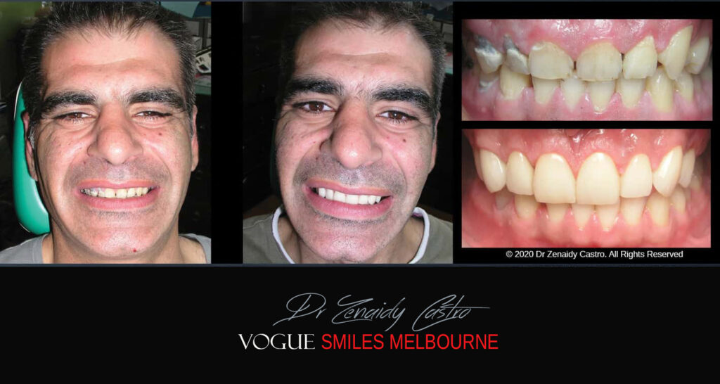 Porcelain Veneers near Wheelers Hill area - Before and After Pictures - Dental Veneers - Tooth Veneers - Top Cosmetic Dentist in Wheelers Hill