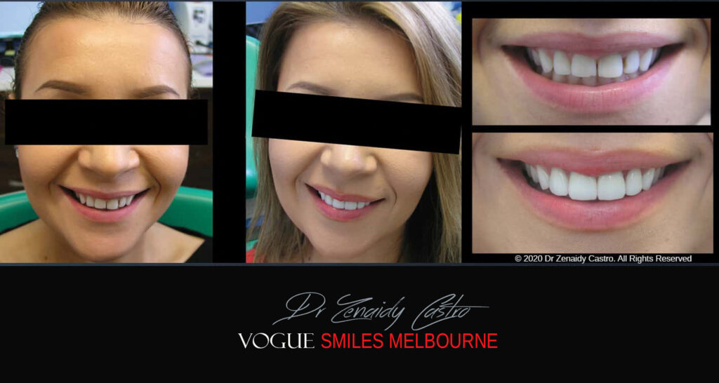 Porcelain Veneers near Wheelers Hill area - Before and After Pictures - Dental Veneers - Tooth Veneers - Top Cosmetic Dentist in Wheelers Hill