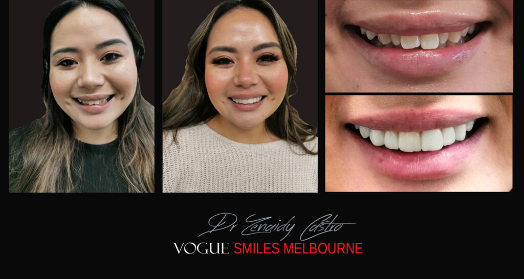 Porcelain Veneers near Wheelers Hill area - Before and After Pictures - Dental Veneers - Tooth Veneers - Top Cosmetic Dentist in Wheelers Hill