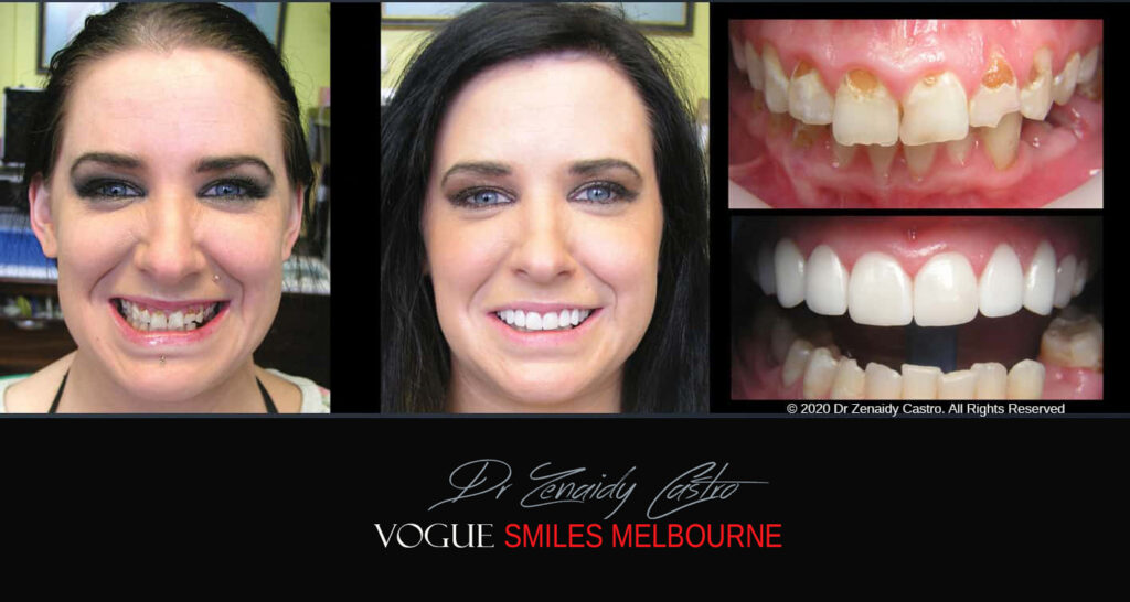 Porcelain Veneers near Wheelers Hill area - Before and After Pictures - Dental Veneers - Tooth Veneers - Top Cosmetic Dentist in Wheelers Hill