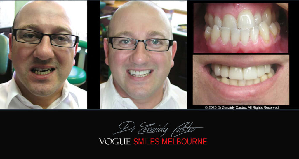 Porcelain Veneers near Wheelers Hill area - Before and After Pictures - Dental Veneers - Tooth Veneers - Top Cosmetic Dentist in Wheelers Hill