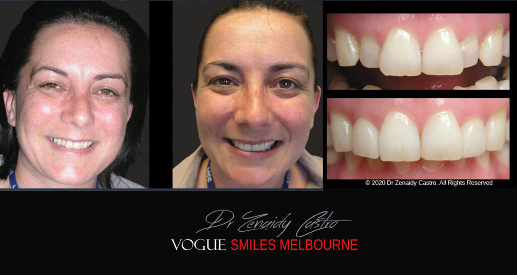 Porcelain Veneers near Wheelers Hill area - Before and After Pictures - Dental Veneers - Tooth Veneers - Top Cosmetic Dentist in Wheelers Hill