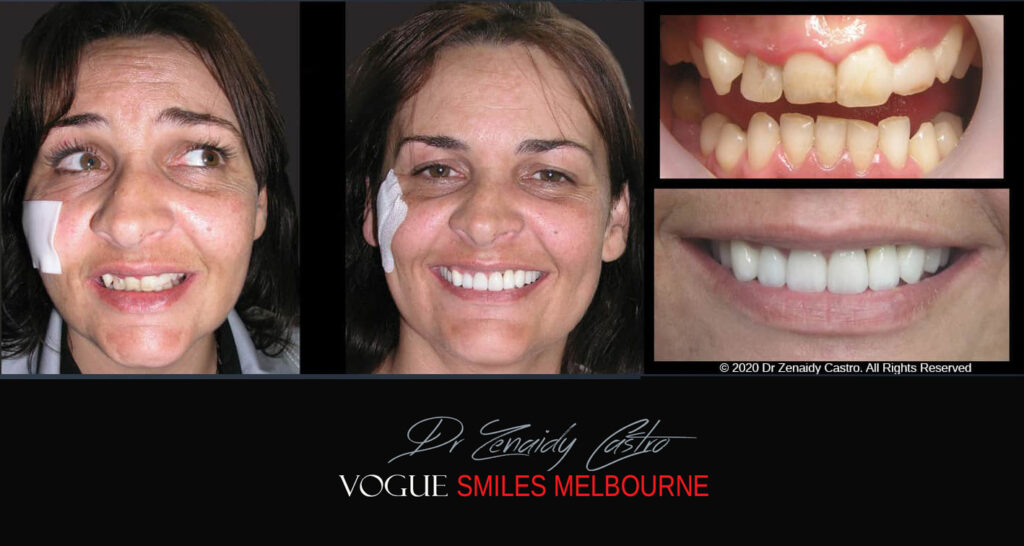 Porcelain Veneers near Wheelers Hill area - Before and After Pictures - Dental Veneers - Tooth Veneers - Top Cosmetic Dentist in Wheelers Hill