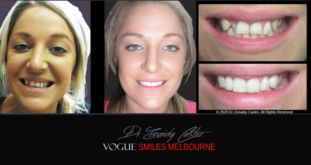 Porcelain Veneers near Wheelers Hill area - Before and After Pictures - Dental Veneers - Tooth Veneers - Top Cosmetic Dentist in Wheelers Hill