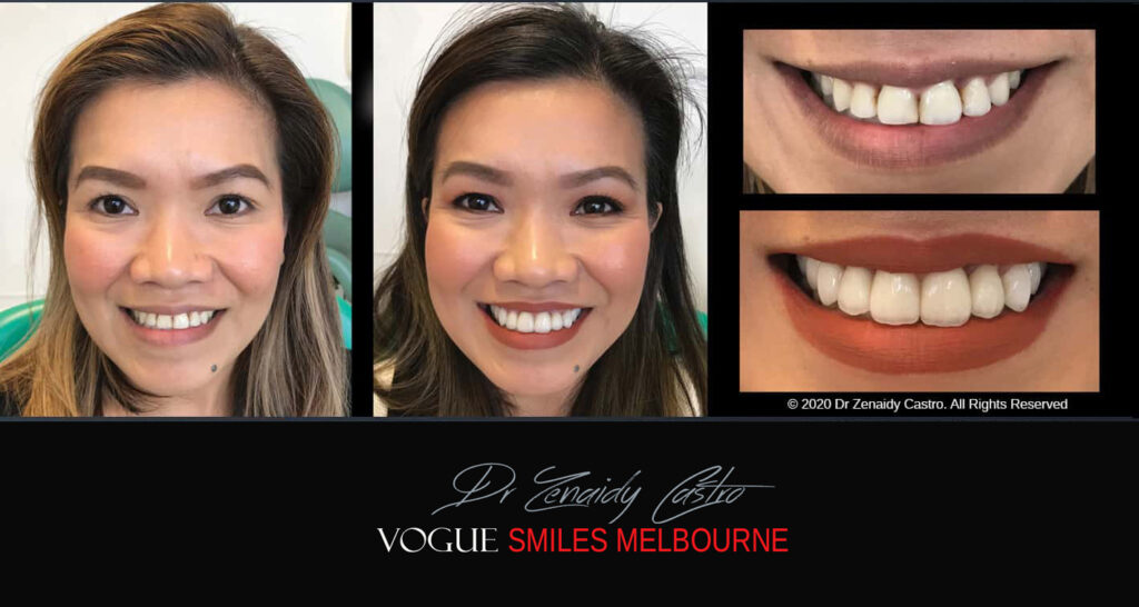 Porcelain Veneers near Wheelers Hill area - Before and After Pictures - Dental Veneers - Tooth Veneers - Top Cosmetic Dentist in Wheelers Hill