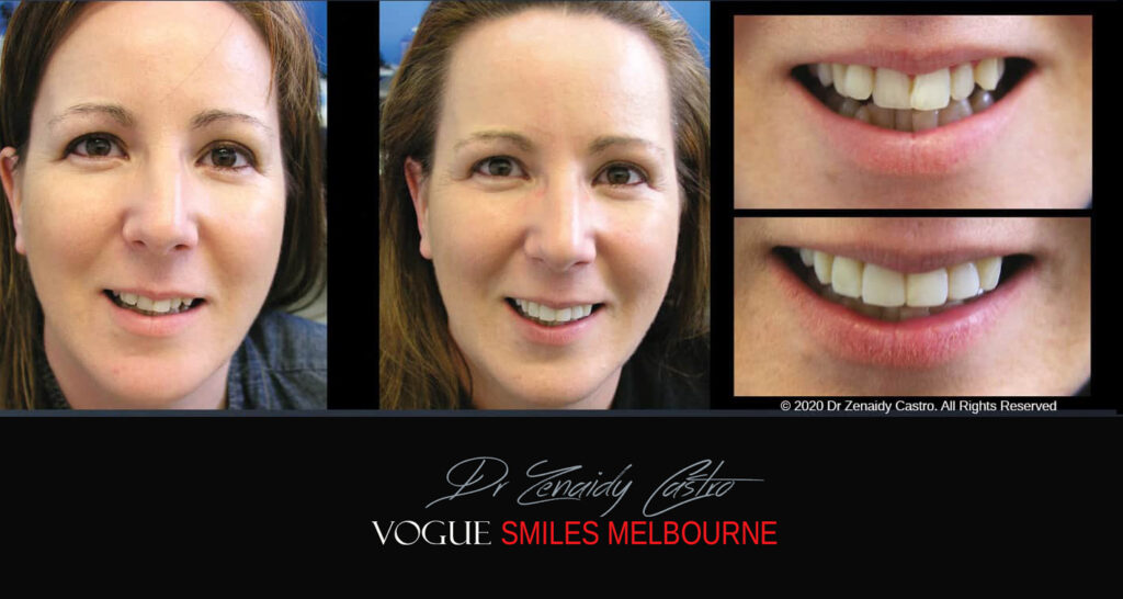 Porcelain Veneers near Wheelers Hill area - Before and After Pictures - Dental Veneers - Tooth Veneers - Top Cosmetic Dentist in Wheelers Hill