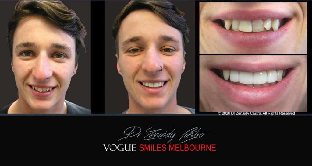 Porcelain Veneers near Wheelers Hill area - Before and After Pictures - Dental Veneers - Tooth Veneers - Top Cosmetic Dentist in Wheelers Hill