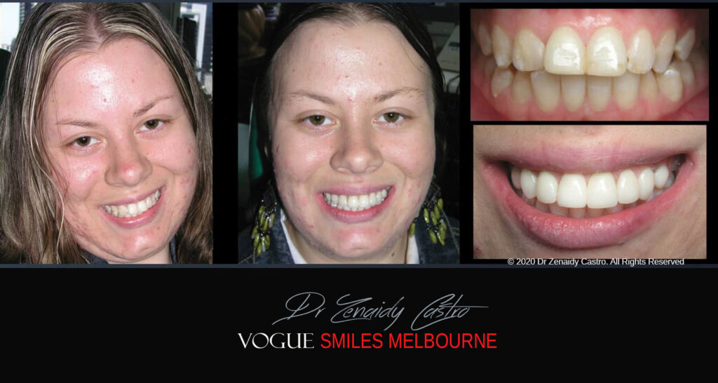 Porcelain Veneers near Wheelers Hill area - Before and After Pictures - Dental Veneers - Tooth Veneers - Top Cosmetic Dentist in Wheelers Hill