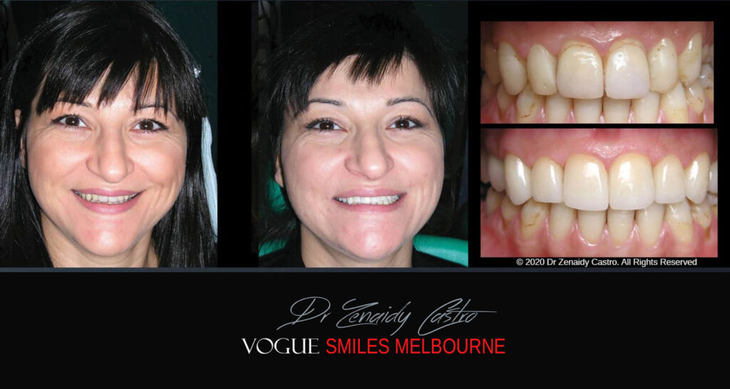 Porcelain Veneers near Wheelers Hill area - Before and After Pictures - Dental Veneers - Tooth Veneers - Top Cosmetic Dentist in Wheelers Hill