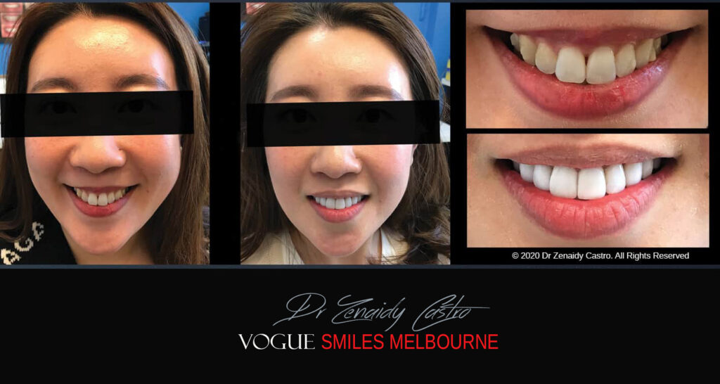 Porcelain Veneers near Wheelers Hill area - Before and After Pictures - Dental Veneers - Tooth Veneers - Top Cosmetic Dentist in Wheelers Hill