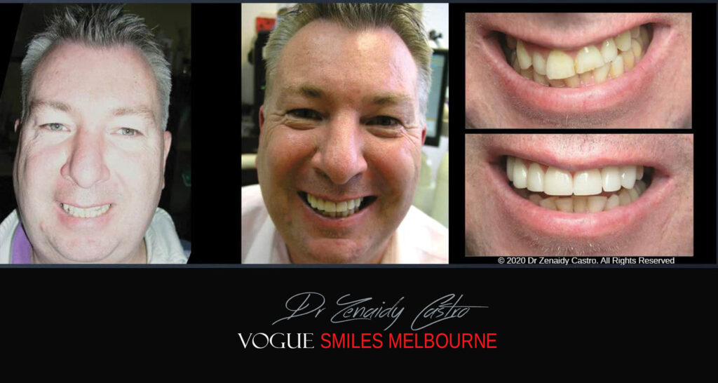 Porcelain Veneers near Wheelers Hill area - Before and After Pictures - Dental Veneers - Tooth Veneers - Top Cosmetic Dentist in Wheelers Hill