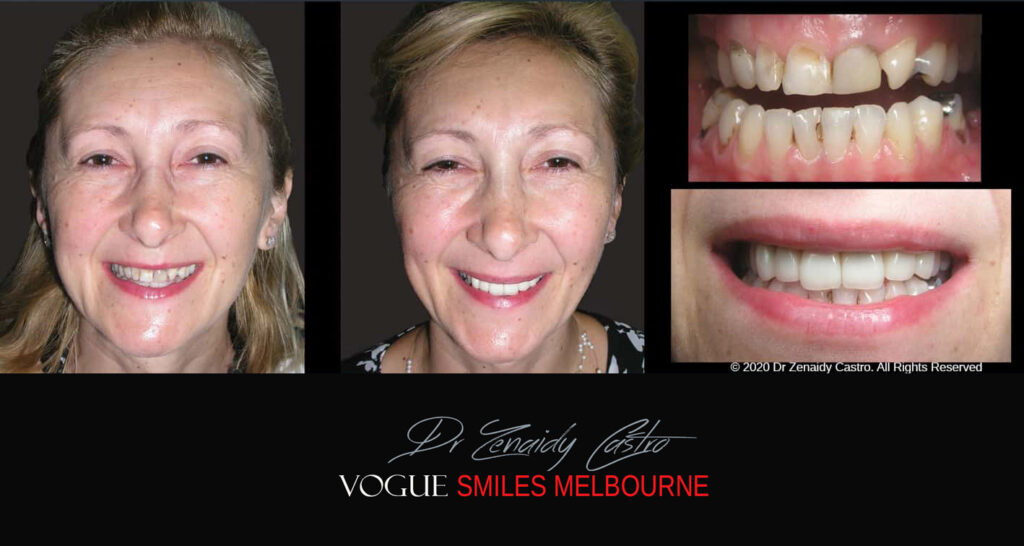Porcelain Veneers near Wheelers Hill area - Before and After Pictures - Dental Veneers - Tooth Veneers - Top Cosmetic Dentist in Wheelers Hill