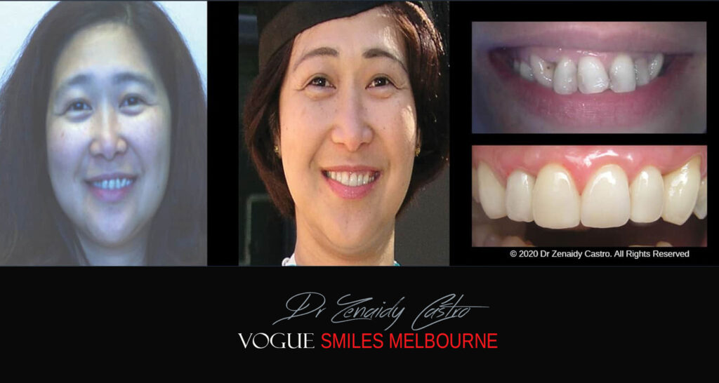 Porcelain Veneers near Wheelers Hill area - Before and After Pictures - Dental Veneers - Tooth Veneers - Top Cosmetic Dentist in Wheelers Hill