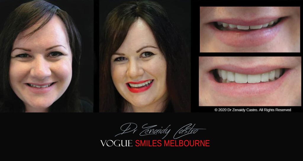 Porcelain Veneers near Wheelers Hill area - Before and After Pictures - Dental Veneers - Tooth Veneers - Top Cosmetic Dentist in Wheelers Hill