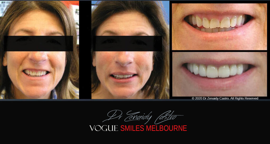 Porcelain Veneers near Wheelers Hill area - Before and After Pictures - Dental Veneers - Tooth Veneers - Top Cosmetic Dentist in Wheelers Hill
