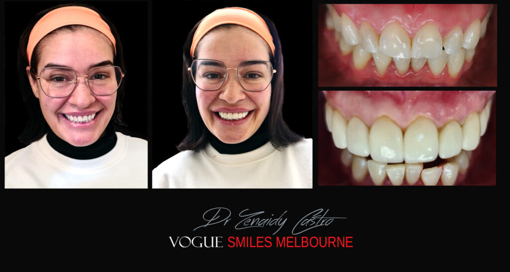 Porcelain Veneers near Wheelers Hill area - Before and After Pictures - Dental Veneers - Tooth Veneers - Top Cosmetic Dentist in Wheelers Hill