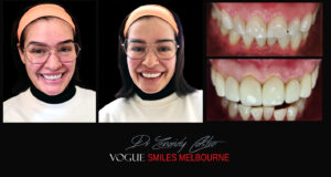 Cost of Smile Makeover in Noble Park North