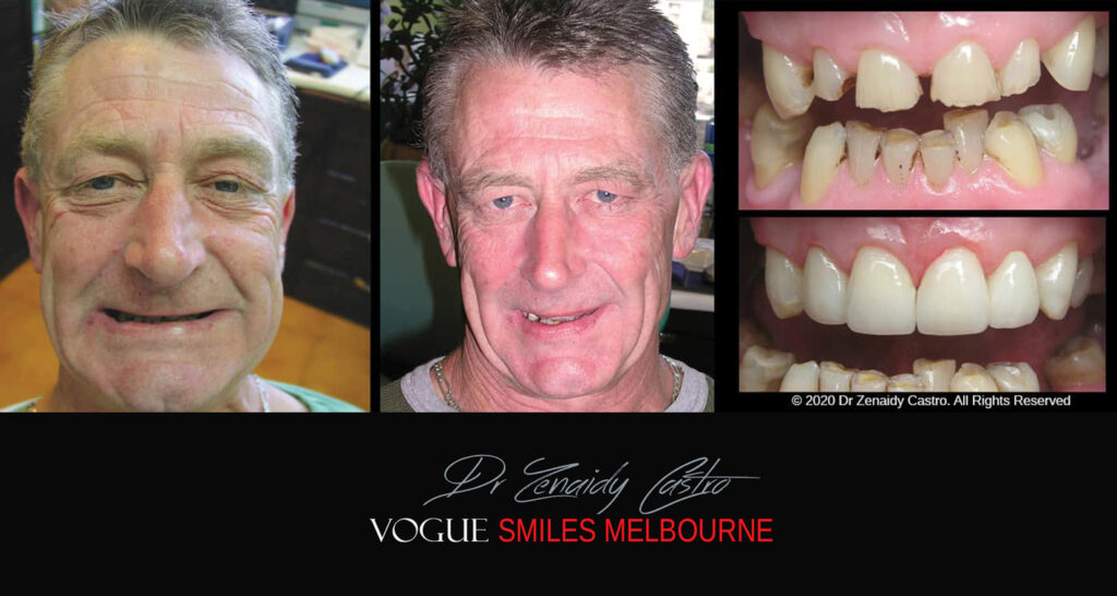 Porcelain Veneers near Wheelers Hill area - Before and After Pictures - Dental Veneers - Tooth Veneers - Top Cosmetic Dentist in Wheelers Hill
