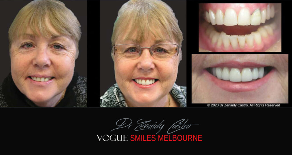Porcelain Veneers near Wheelers Hill area - Before and After Pictures - Dental Veneers - Tooth Veneers - Top Cosmetic Dentist in Wheelers Hill