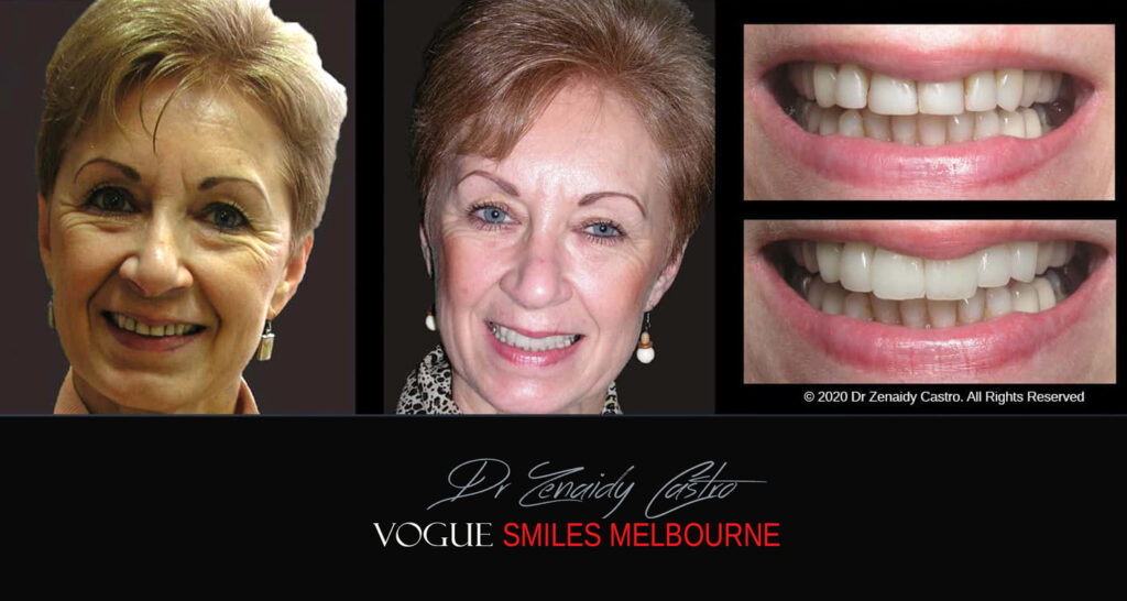 Porcelain Veneers near Wheelers Hill area - Before and After Pictures - Dental Veneers - Tooth Veneers - Top Cosmetic Dentist in Wheelers Hill