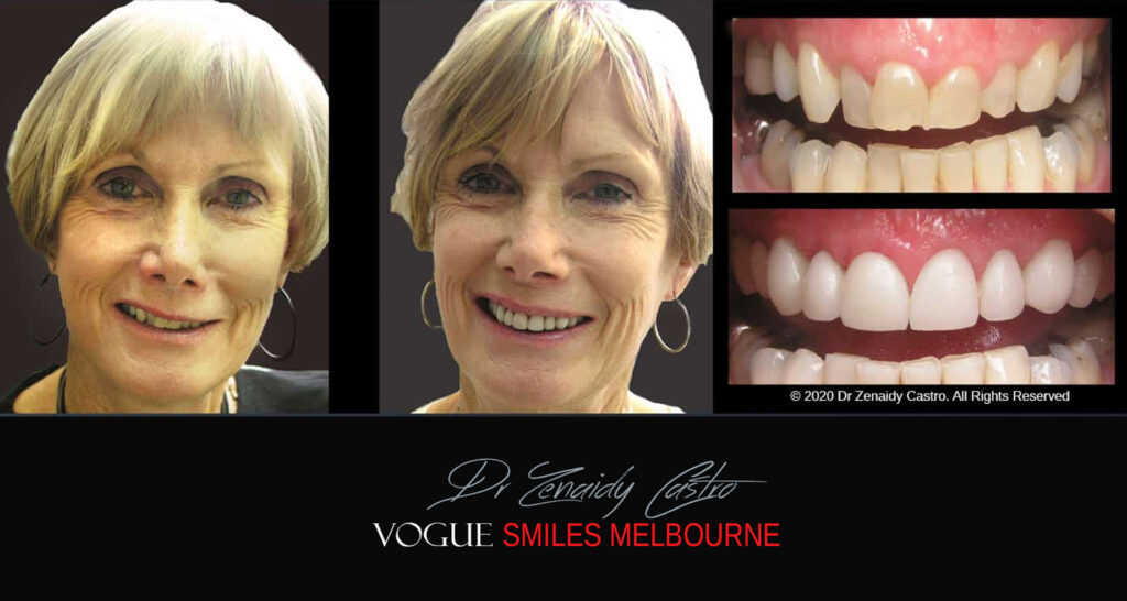Porcelain Veneers near Wheelers Hill area - Before and After Pictures - Dental Veneers - Tooth Veneers - Top Cosmetic Dentist in Wheelers Hill