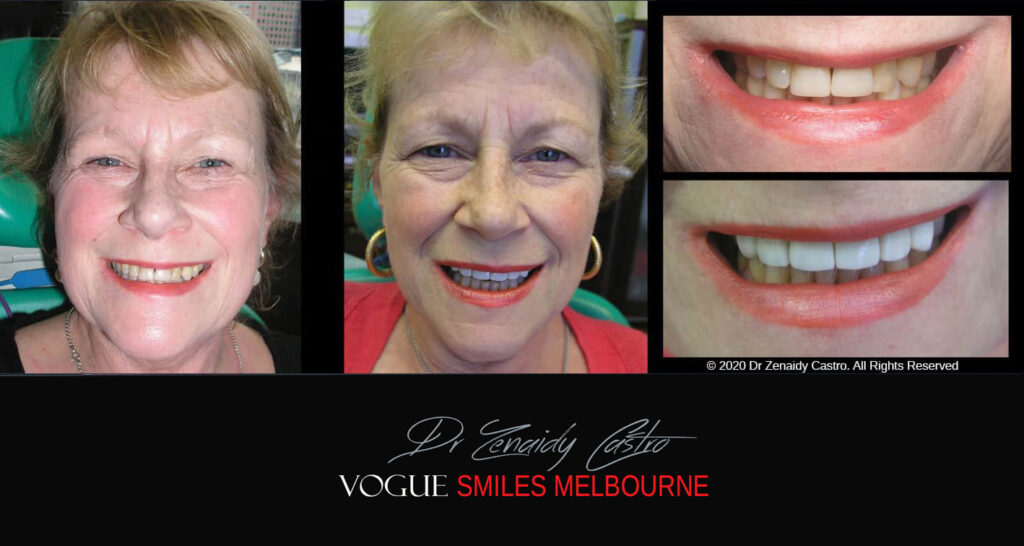 Porcelain Veneers near Wheelers Hill area - Before and After Pictures - Dental Veneers - Tooth Veneers - Top Cosmetic Dentist in Wheelers Hill
