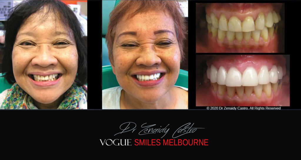 Porcelain Veneers near Wheelers Hill area - Before and After Pictures - Dental Veneers - Tooth Veneers - Top Cosmetic Dentist in Wheelers Hill