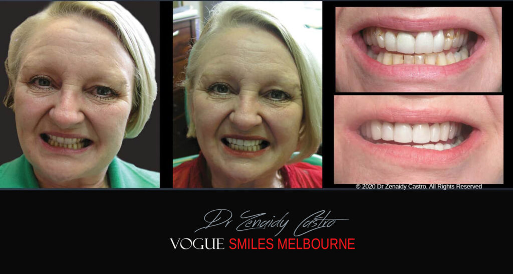 Porcelain Veneers near Wheelers Hill area - Before and After Pictures - Dental Veneers - Tooth Veneers - Top Cosmetic Dentist in Wheelers Hill