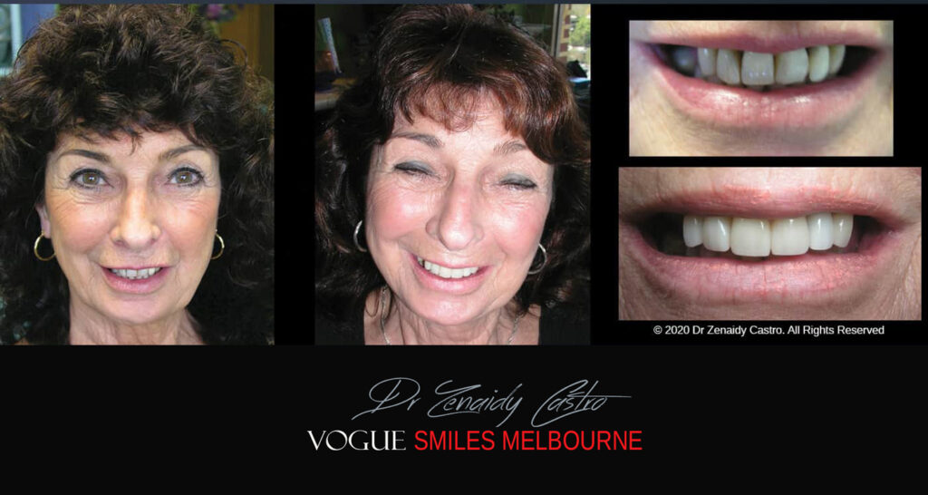 Porcelain Veneers near Wheelers Hill area - Before and After Pictures - Dental Veneers - Tooth Veneers - Top Cosmetic Dentist in Wheelers Hill