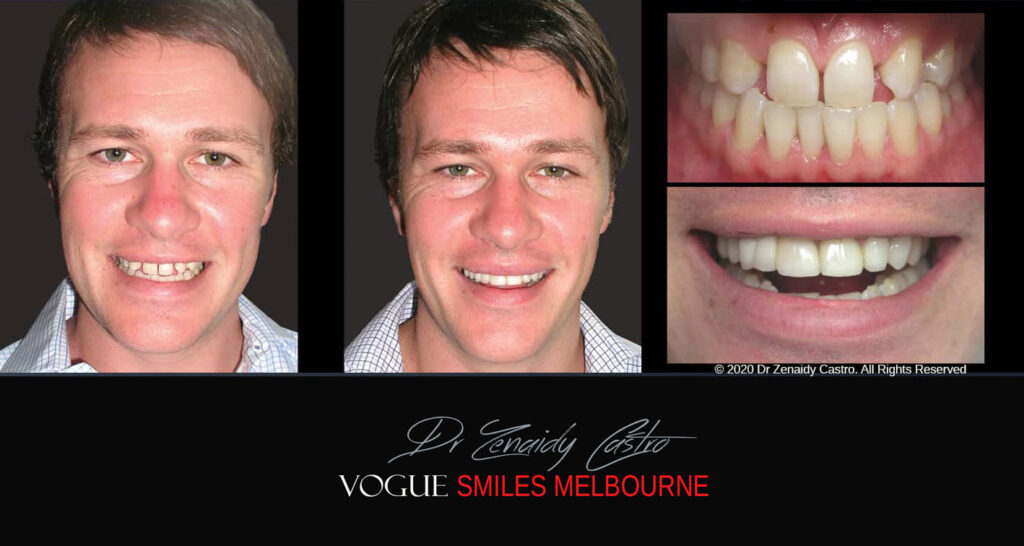 Porcelain Veneers near Wheelers Hill area - Before and After Pictures - Dental Veneers - Tooth Veneers - Top Cosmetic Dentist in Wheelers Hill