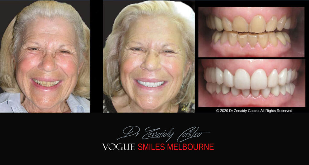 Porcelain Veneers near Wheelers Hill area - Before and After Pictures - Dental Veneers - Tooth Veneers - Top Cosmetic Dentist in Wheelers Hill