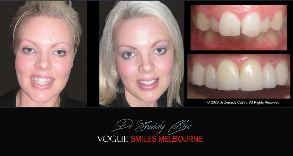 Porcelain Veneers near Wheelers Hill area - Before and After Pictures - Dental Veneers - Tooth Veneers - Top Cosmetic Dentist in Wheelers Hill