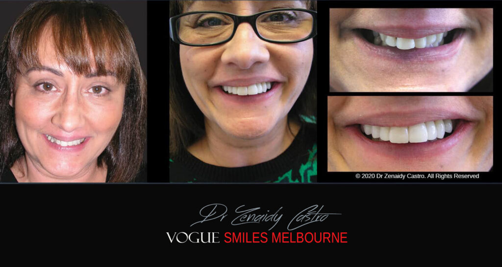 Porcelain Veneers near Wheelers Hill area - Before and After Pictures - Dental Veneers - Tooth Veneers - Top Cosmetic Dentist in Wheelers Hill