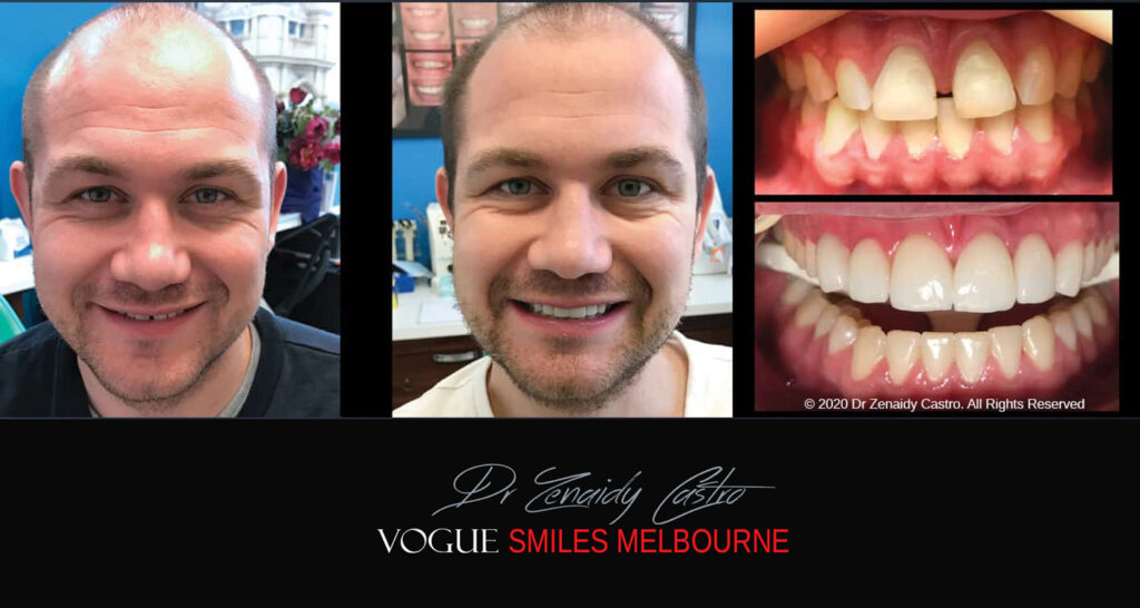 Porcelain Veneers near Wheelers Hill area - Before and After Pictures - Dental Veneers - Tooth Veneers - Top Cosmetic Dentist in Wheelers Hill