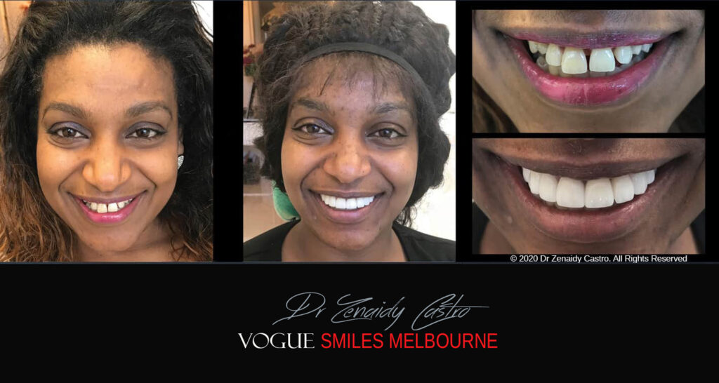 Porcelain Veneers near Wheelers Hill area - Before and After Pictures - Dental Veneers - Tooth Veneers - Top Cosmetic Dentist in Wheelers Hill