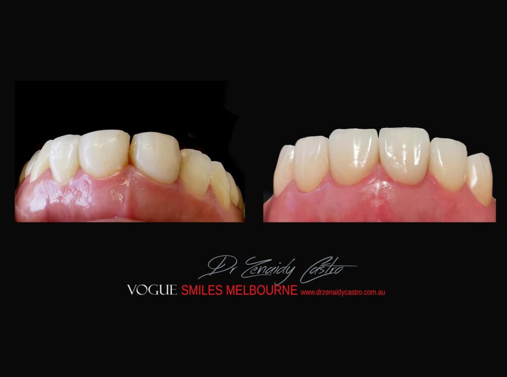 Prepless-No-Grinding-Lumineers-Porcelain-Veneers